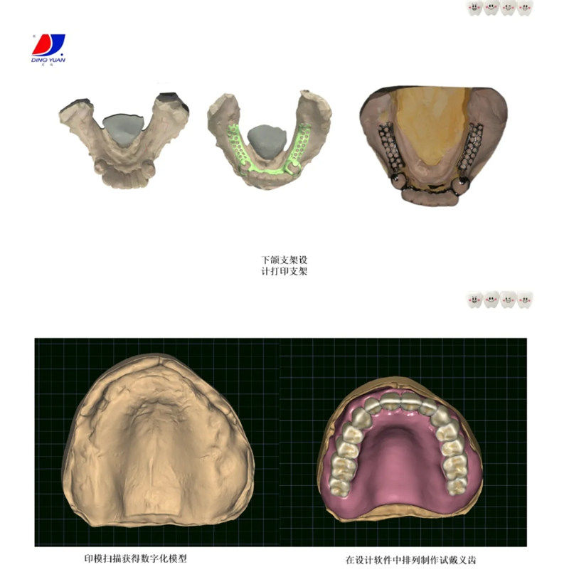 數(shù)字化全口義齒臨床應(yīng)用實(shí)戰(zhàn)